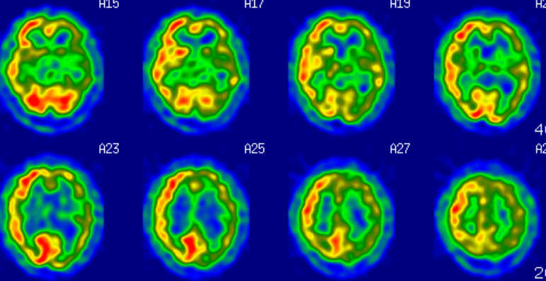 脳神経内科領域で威力を発揮する超音波検査