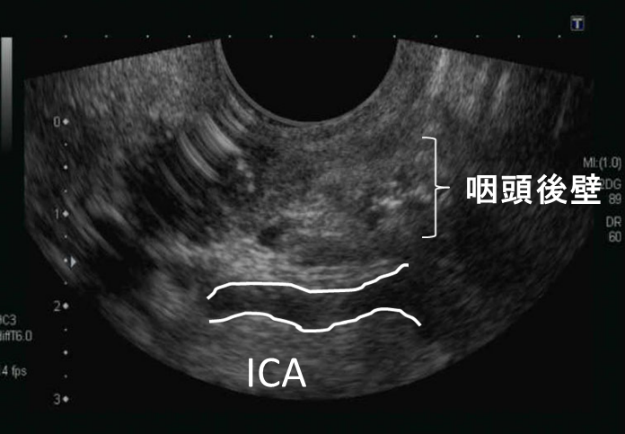 脳神経内科領域で威力を発揮する超音波検査