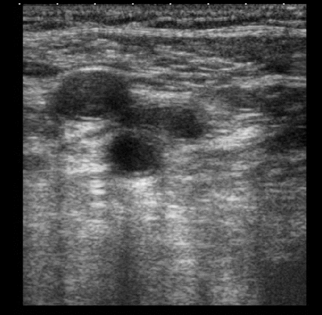 脳神経内科領域で威力を発揮する超音波検査