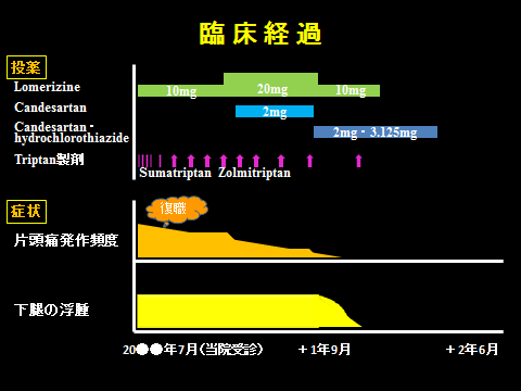 片頭痛の新しい予防療法